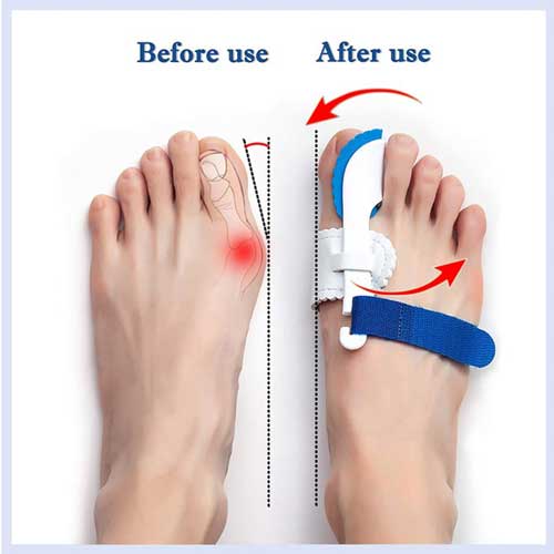 Bunions - kit de suport pentru bunion